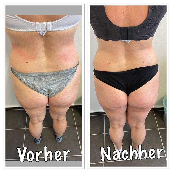 Ergebnisse der Madero Massage nach 4 Behandlungen in 2 Wochen – Rücken-Ansicht