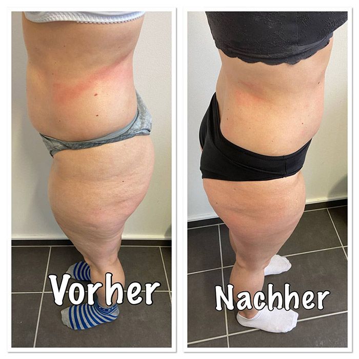 Ergebnisse der Madero Massage nach 4 Behandlungen in 2 Wochen – seitliche Ansicht