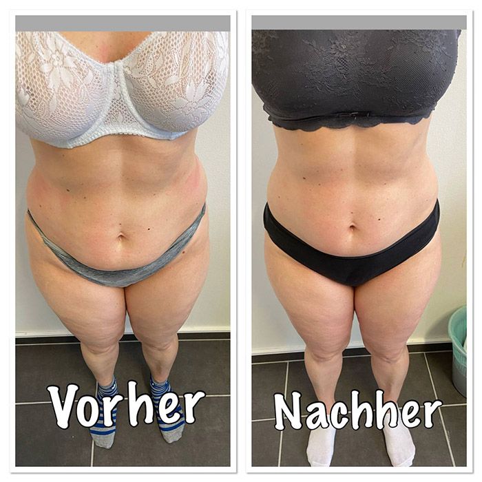 Ergebnisse der Madero Massage nach 4 Behandlungen in 2 Wochen – Bauch-Ansicht